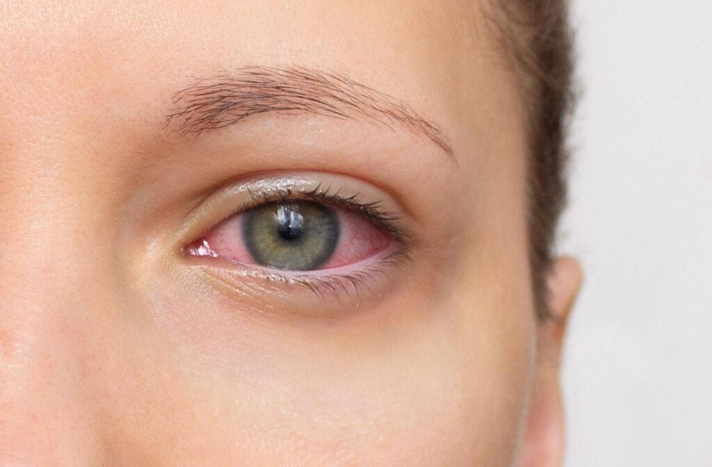 a red eye caused by dry eye