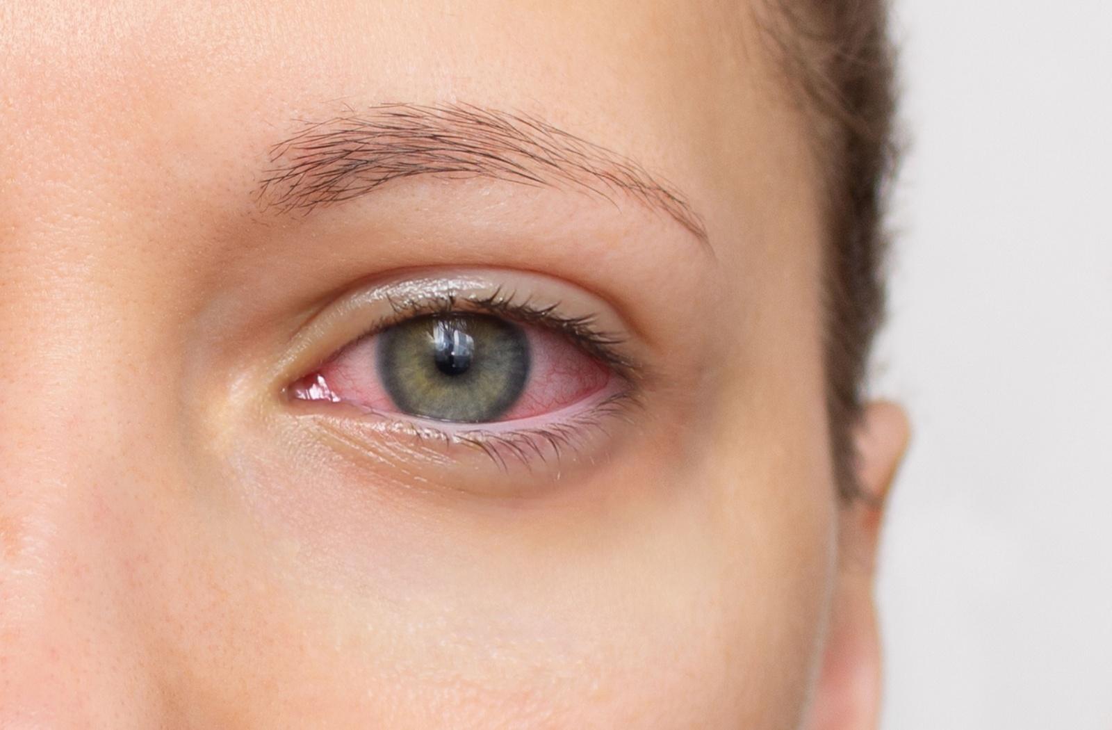 a red eye caused by dry eye